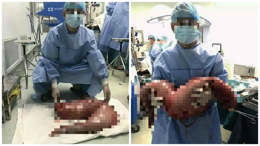 上海一名男子肚子大到如9個月大的孕婦，經檢查後罹患了「先天性巨大結腸症」，開刀取出重達13公斤的屎腸。(圖／翻攝自Medicine for dummies臉書粉絲團)