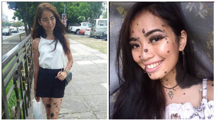 馬來西亞這名20歲少女儘管全身布滿黑痣，但她仍十分有自信，還參加大馬環球小姐的選拔。(圖／翻攝自IG)