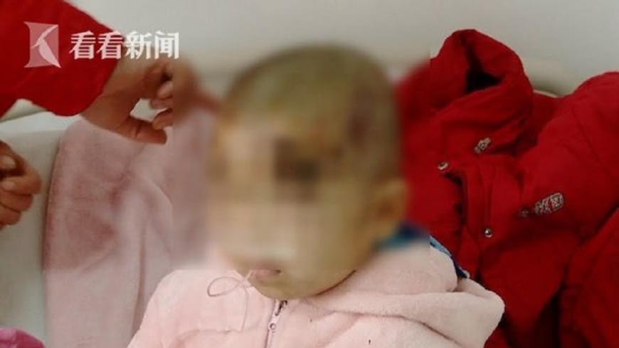 5歲小男童為了保護2歲妹妹，遭到鄰居飼養的藏獒狂咬，全身一共縫了38針。(圖／翻攝自看看新聞)