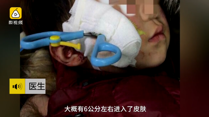 圖／梨視頻 2歲童玩剪刀摔倒　刀刃3公分直插頭顱