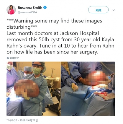 美國阿拉巴馬州女子有巨型卵巢囊腫。翻攝自Rosanna Smith Twitter - 美國阿拉巴馬州女子有巨型卵巢囊腫。翻攝自Rosanna Smith Twitter.jpg 圖/翻攝自Rosanna Smith Twitter