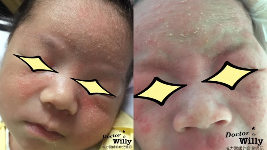醫師說若嬰兒臉上出現「青春痘」,只需用溫水清潔即可。圖/翻攝自「威力醫師的育兒週記-王韋力」