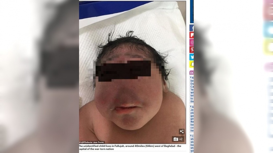 無鼻嬰兒。圖/翻攝自《每日郵報》