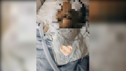 少年3度癌症復發「不想剩半張臉」 父淚:幫幫我