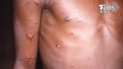 全球猴痘已87例　疾管署籲「3症狀」警覺