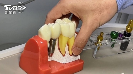 植牙「牙科骨內植體」仿品流竄　食藥署曝批號外觀