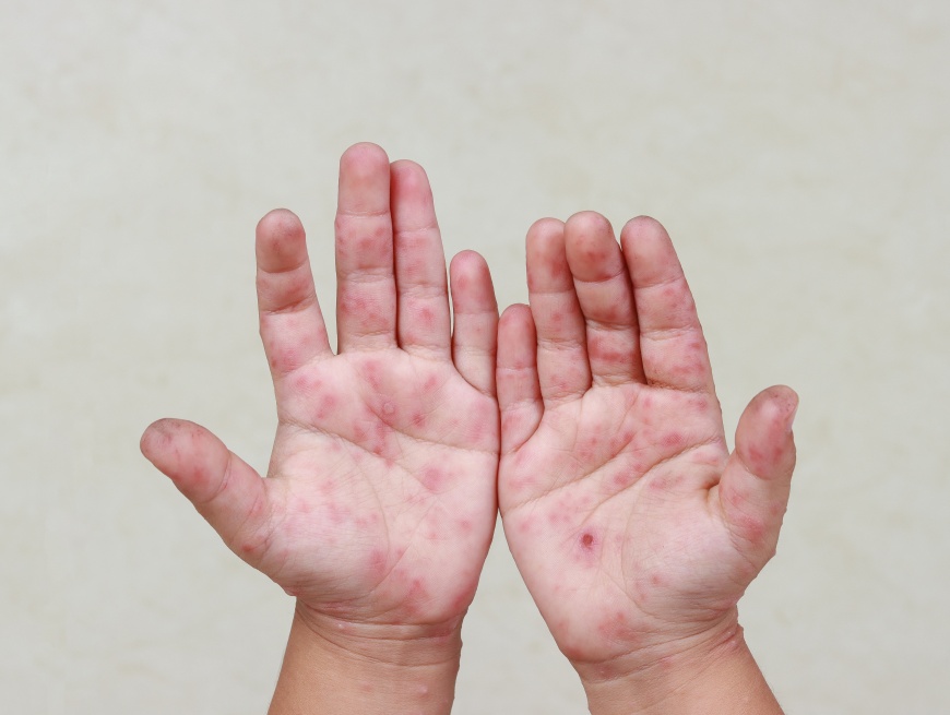 腸病毒典型症狀為手腳長出紅疹或水泡（圖檔來源/shutterstock）