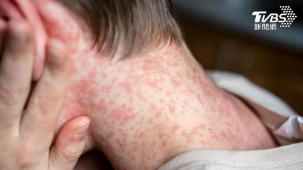 台北麻疹個案再+1　10多歲外籍男足跡集中士林區