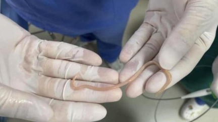 腹痛找嘸原因！陸女照大腸鏡　驚見「10公分活蟲」蠕動