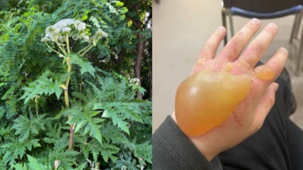 世界第一危險猛毒植物疑入侵北海道　摸了腫巨大水泡