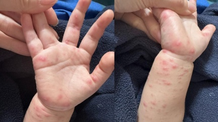 隱瞞兒女腸病毒害15童染疫　高雄醫護夫妻挨罰12萬