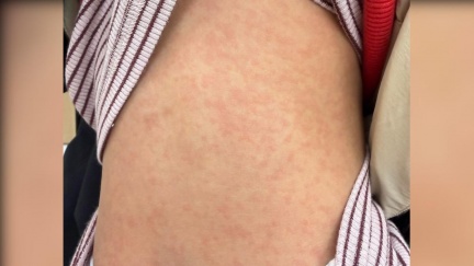 天冷穿錯害慘孩子！「1保暖神物」竟是紅疹元兇