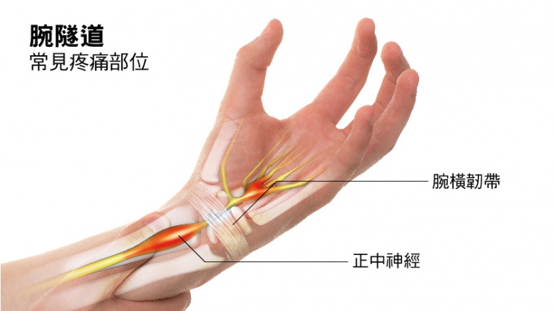 手指麻木刺痛逾２周 可能是腕隧道症候群