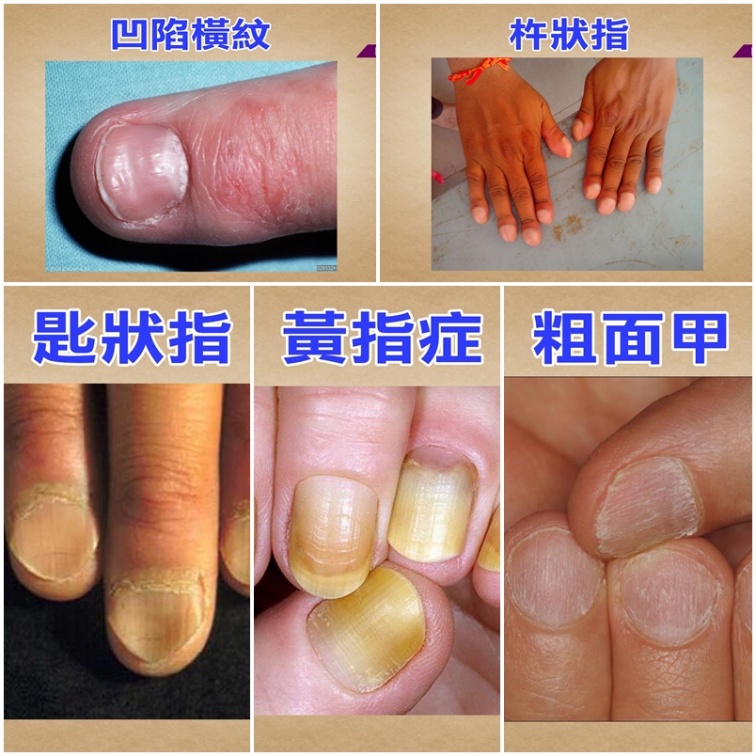 指甲粗糙有橫紋，小心身體出問題！這５種指甲病你有嗎？
