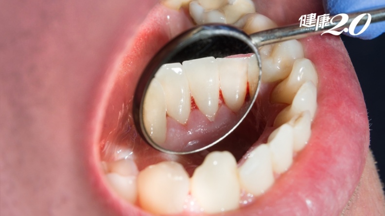 口腔益生菌能改善牙周病嗎？醫揭2方法有效降低牙周病復發