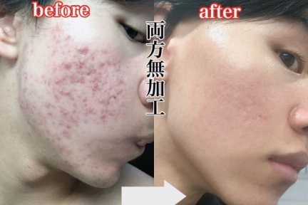 嘴唇小水泡又痛又癢！唇皰疹「發作原因+預防方法」一次看，小心5情況恐復發！