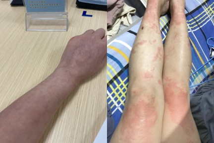 嘴唇小水泡又痛又癢！唇皰疹「發作原因+預防方法」一次看，小心5情況恐復發！