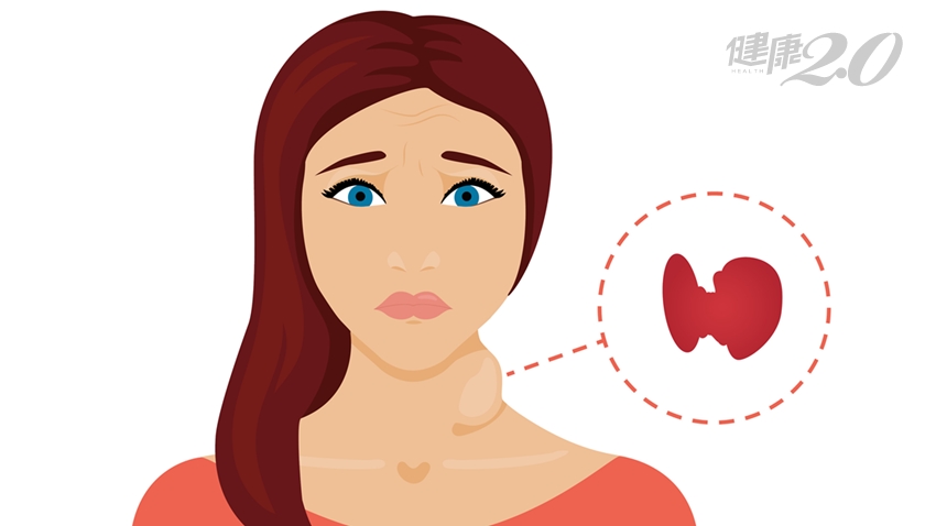 甲狀腺亢進不僅會腫脖、凸眼，9種症狀都和它有關！