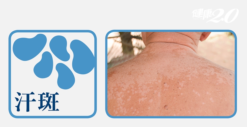 圖解！3種皮膚病是「流汗」害的，原因症狀療法一次告訴你