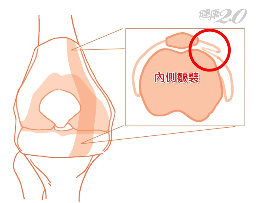 關節權威呂紹睿：確實執行護膝3運動，促進軟骨健康