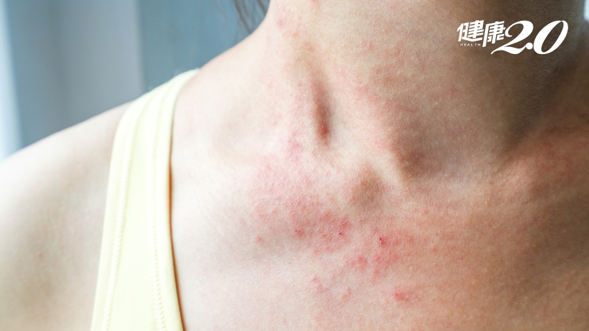 皮膚癢代表肝不好？５種皮膚問題是「肝臟疾病」警訊