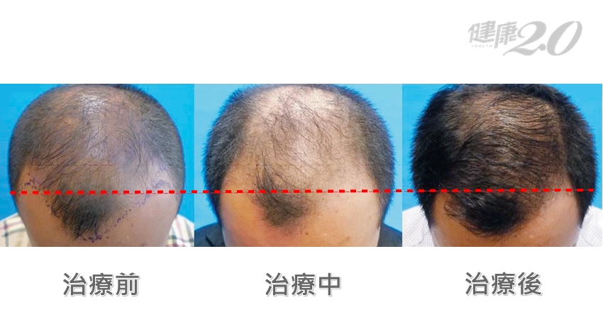 雄性禿男女都有 皮膚科醫：「這部位」開始掉髮要注意！