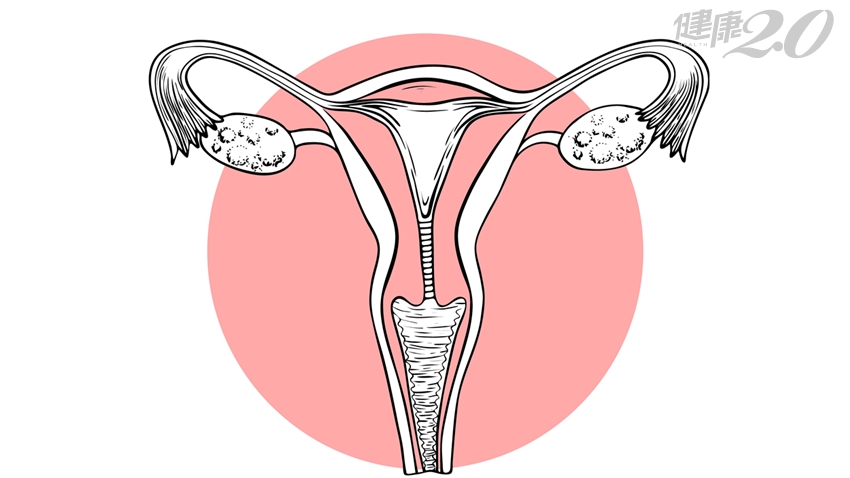 經期變短、血量變少？卵巢有沒有早衰，１張表評估危機