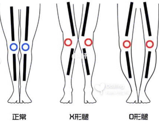 X、O型腿型矯正！睡前6個動作，讓你的腿變得又長又直
