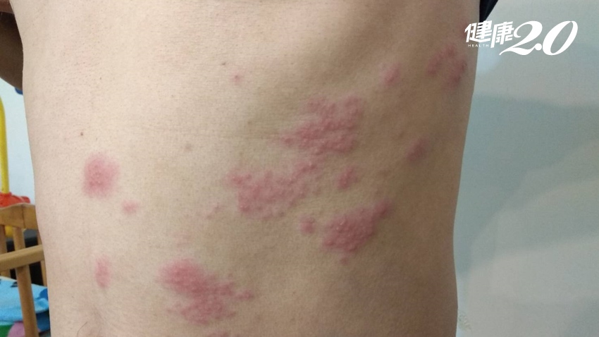 腰部出現紅疹以為蚊蟲咬的？小心「皮蛇」 出現6症狀快就醫