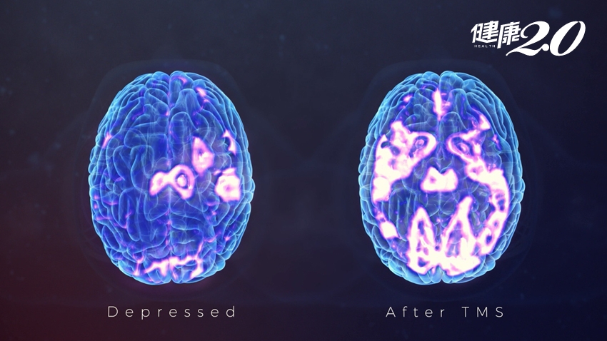 重度憂鬱治療新選擇「經顱磁刺激術」 非侵入性、每次30分鐘活化大腦神經元