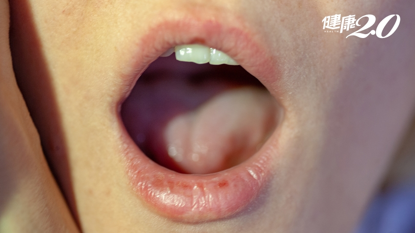 口腔黏膜變粗糙、出現白色網狀條紋，是口腔癌的徵兆？