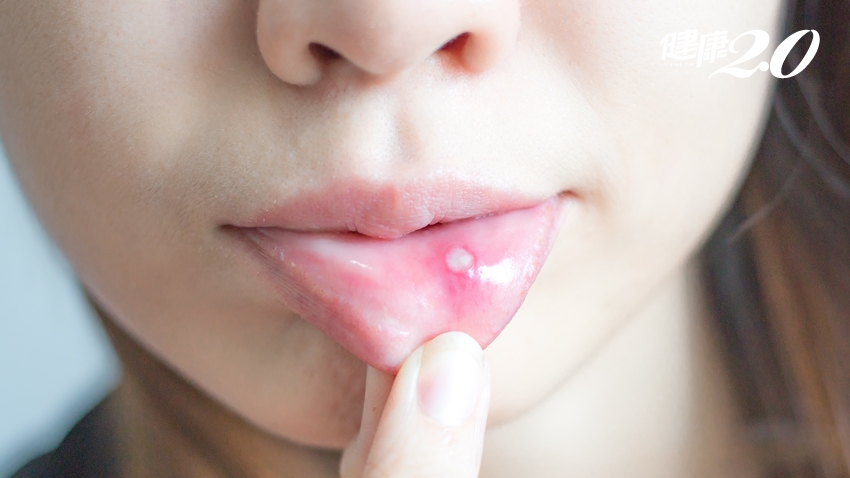 嘴破、口臭、牙齒痛…一張表告訴你 10種口腔問題缺了哪些營養