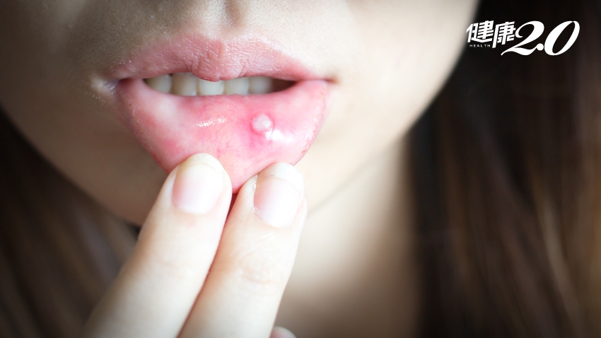 嘴破和口角炎不一樣！會傳染嗎？吞維他命B2有效嗎？