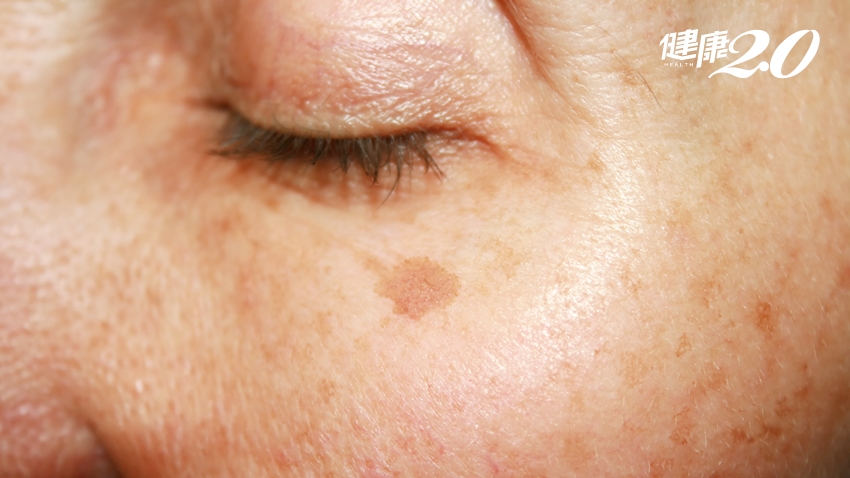陽光好毒？紫外線過量曬出老人斑 2種情形當心皮膚癌！