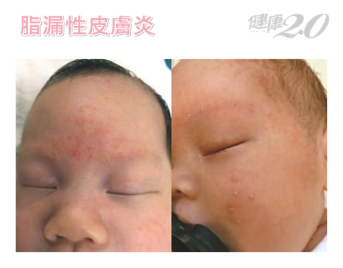 全圖解！長紅疹、胎記、脫皮…寶寶常見8種皮膚問題