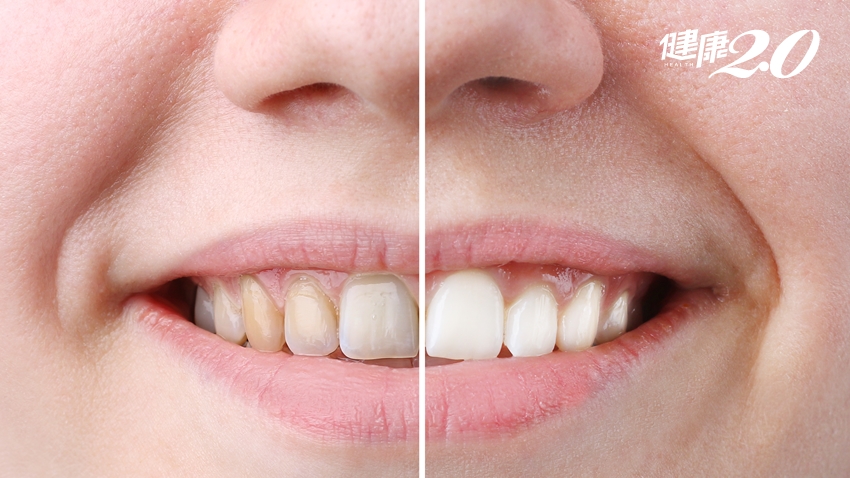 牙齒泛黃有茶垢、菸垢，用「美白貼片」有效嗎？牙醫提醒１點注意
