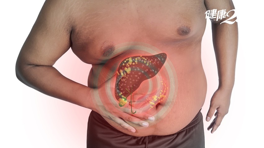 小心脂肪肝會肝硬化、變肝癌！減重加「這」檢查 斷絕脂肪肝