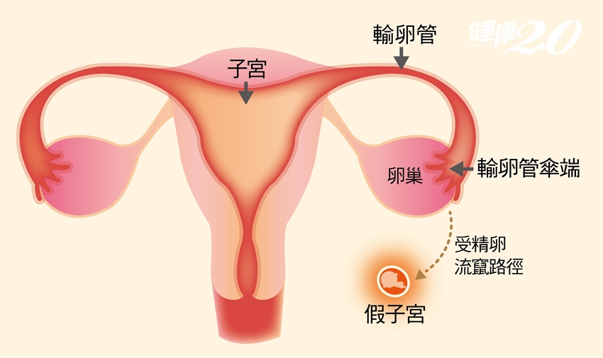 「假子宮」竟受孕…全台20％育齡女性「子宮外孕」風險高人一等