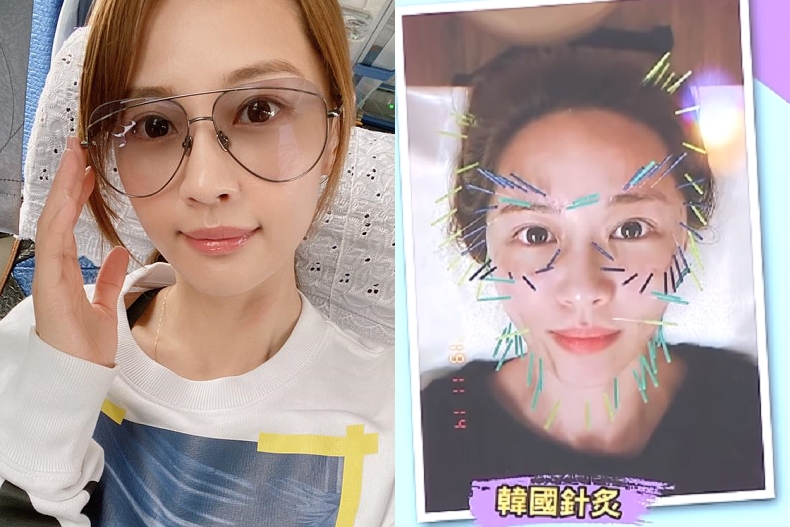 35歲賴薇如滿臉扎針為了消法令紋！風靡演藝圈的「韓國針灸」真的有效？