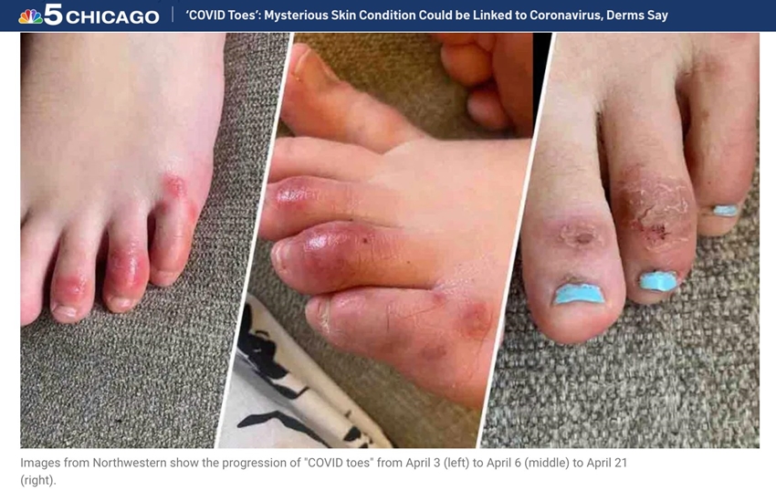 COVID-19新病徵？國外出現「新冠腳趾」！皮膚變紫色、會癢會痛