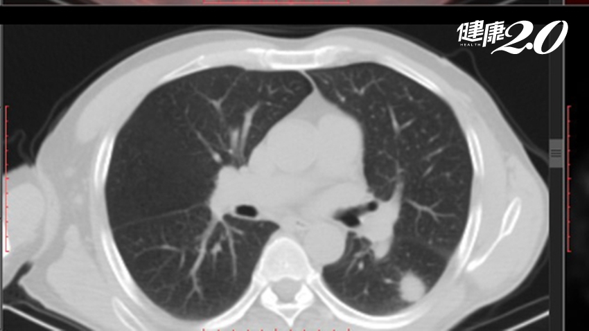 多年沒追蹤，「肺結節」從1顆變多顆！婦女化驗後是「早期肺癌」
