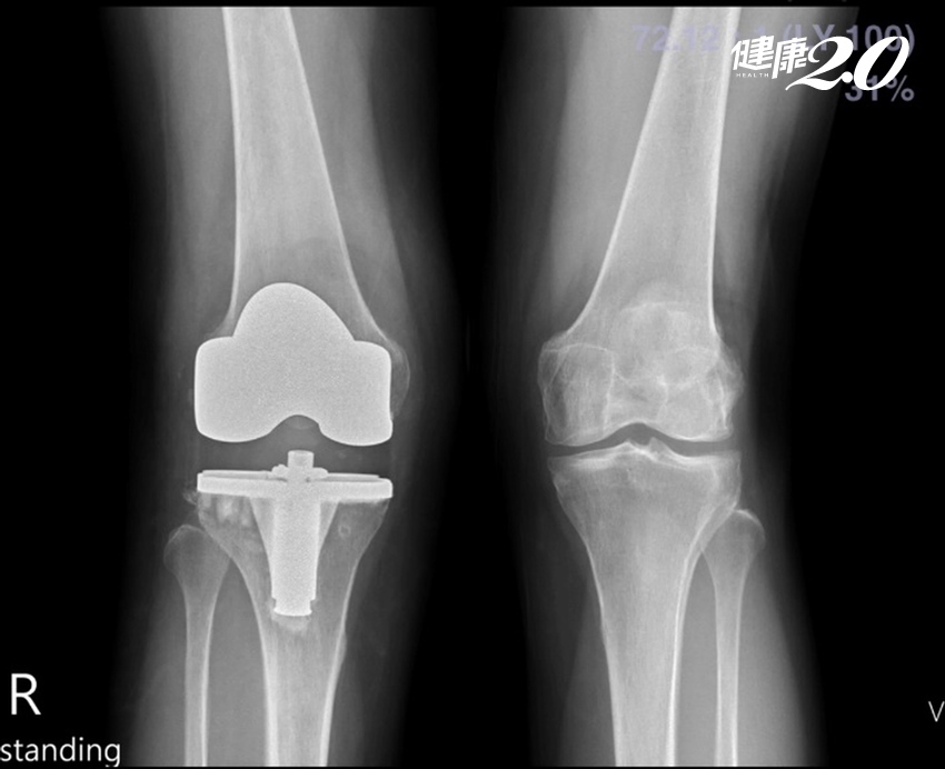 人工膝關節置換術搶救阿嬤的Ｘ型腿 ２周能走還能騎機車