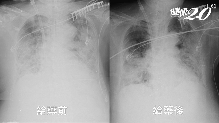 新冠肺炎重症婦人「胸部X光一片白」 類風濕性關節炎藥成功搶回一命！