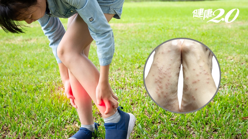 恐怖「小黑蚊」最喜歡咬小腿！走路時不會被叮咬？防蚊液有效嗎？