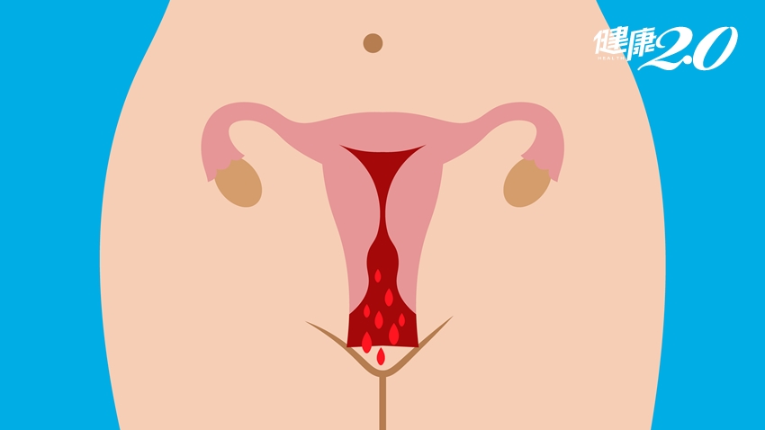 陰道出血可能是癌！醫分析：育齡婦女、更年期、停經後女性病因不同