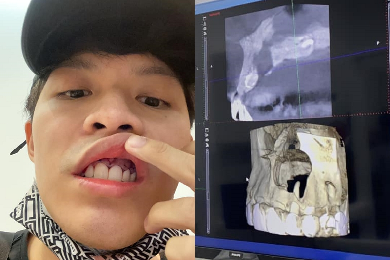牙齦出血變毀容！男歌手忽略牙齦發炎引嚴重後果：鼻下骨頭被蛀大洞