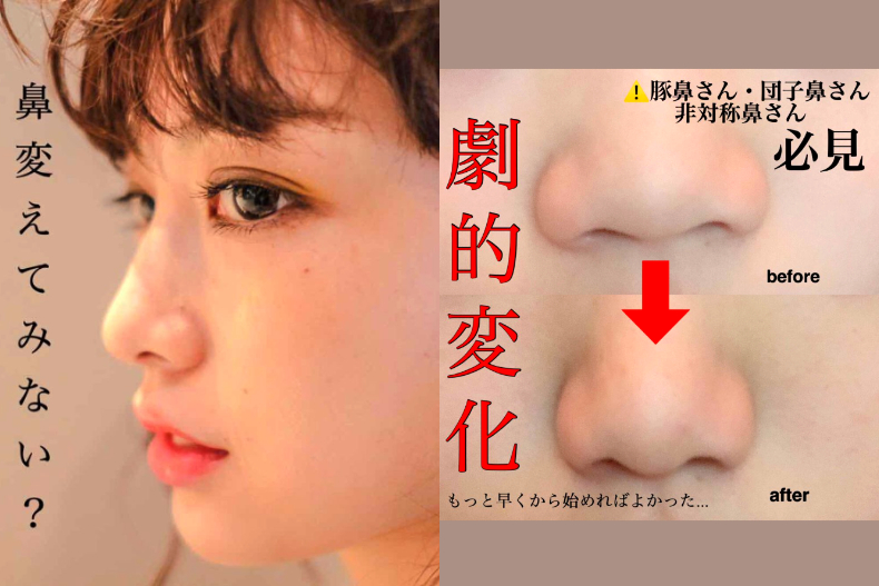 日本爆紅 縮鼻翼按摩 蒜頭鼻日妞含淚實測 5天看見鼻樑 女人我最大