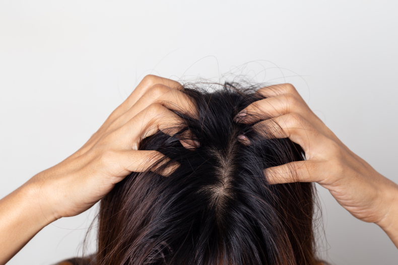 頭皮狂冒痘是怎了？小心難纏的「毛囊炎」失控，會造成永久性掉髮
