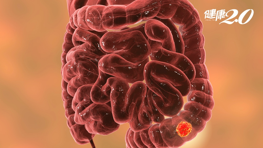 身體出現3種現象，一定要檢查大腸！老翁排便障礙竟是大腸腫瘤造成