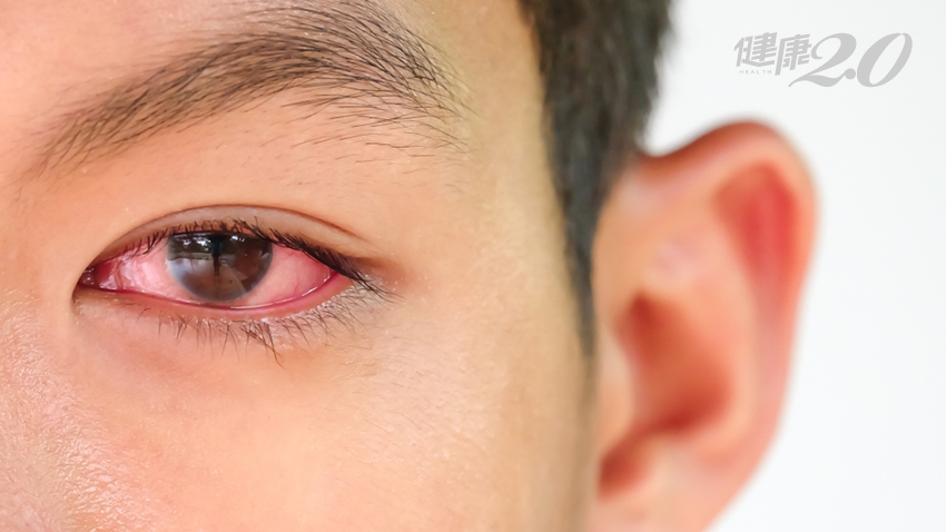 眼睛紅腫以為結膜炎 檢查竟是 眼癌 有些眼癌外觀類似針眼 健康2 0